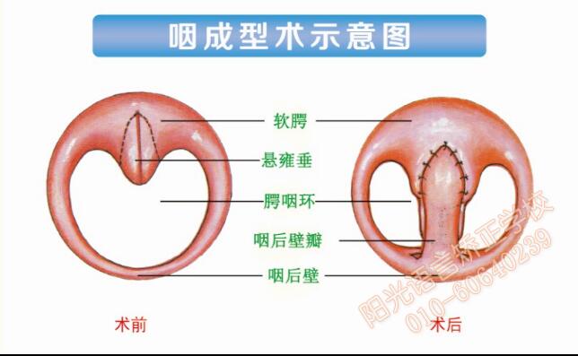 咽成型术示意图