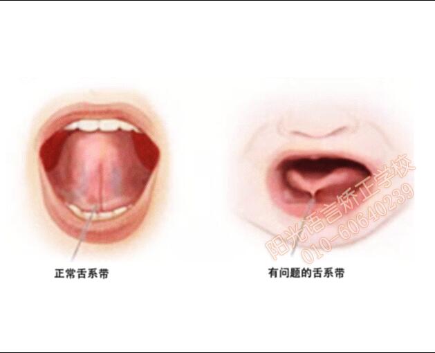 舌系带示意图